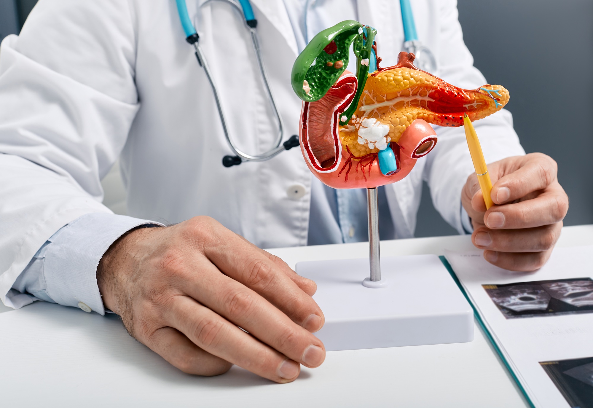 Treatment of pancreatic diseases, acute and chronic pancreatitis. Doctor showing pancreatic disease