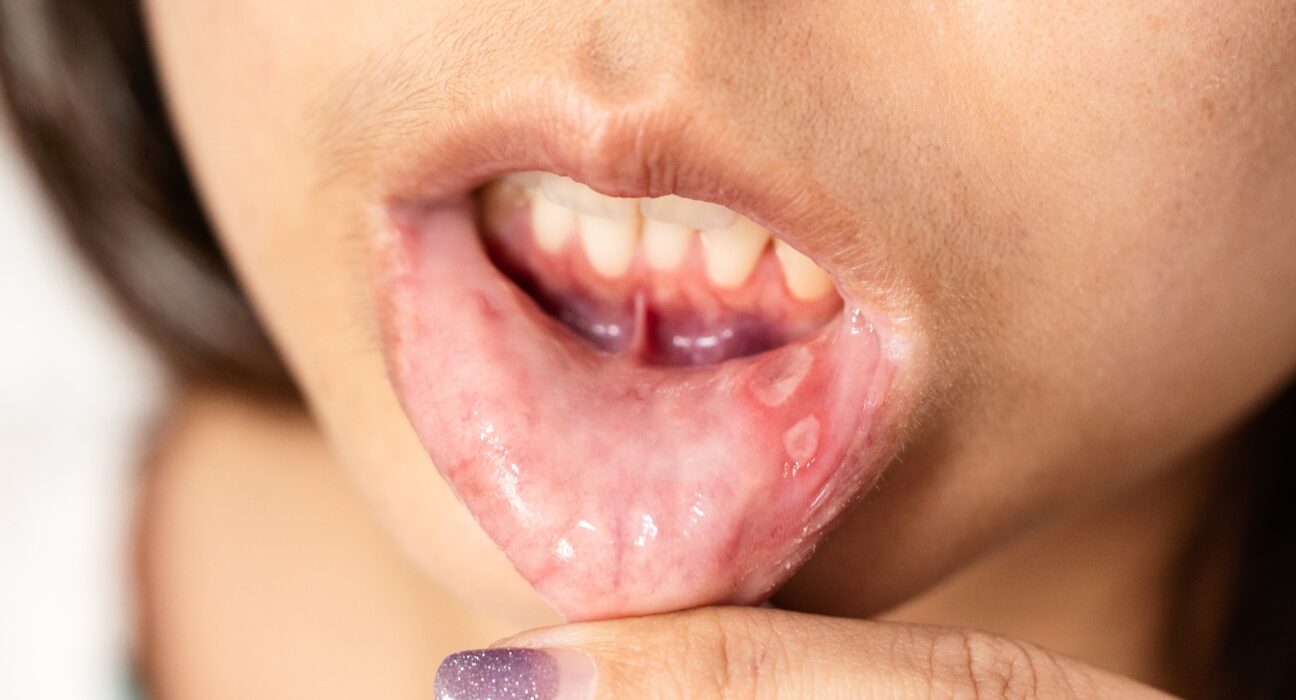 Asian woman have Aphthous ulcer or Canker sore on mouth at lip