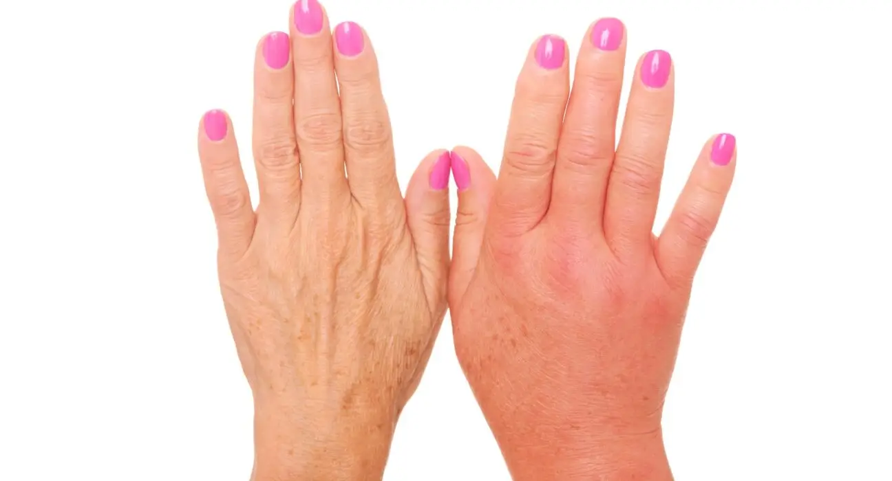 Swollen hand