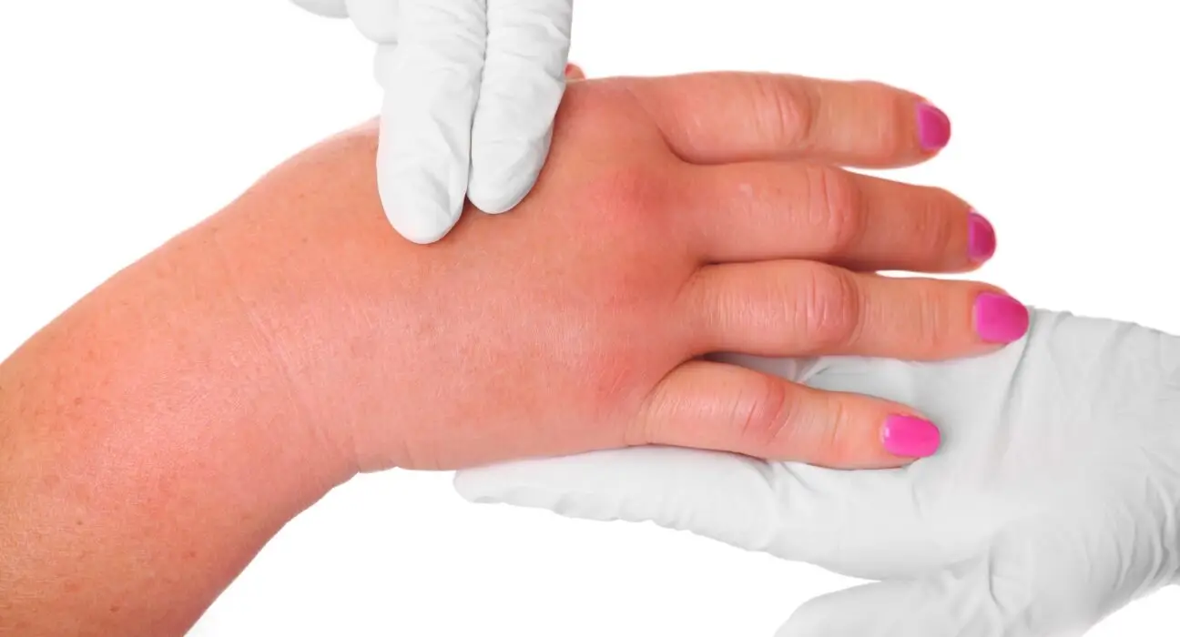 Swollen hand