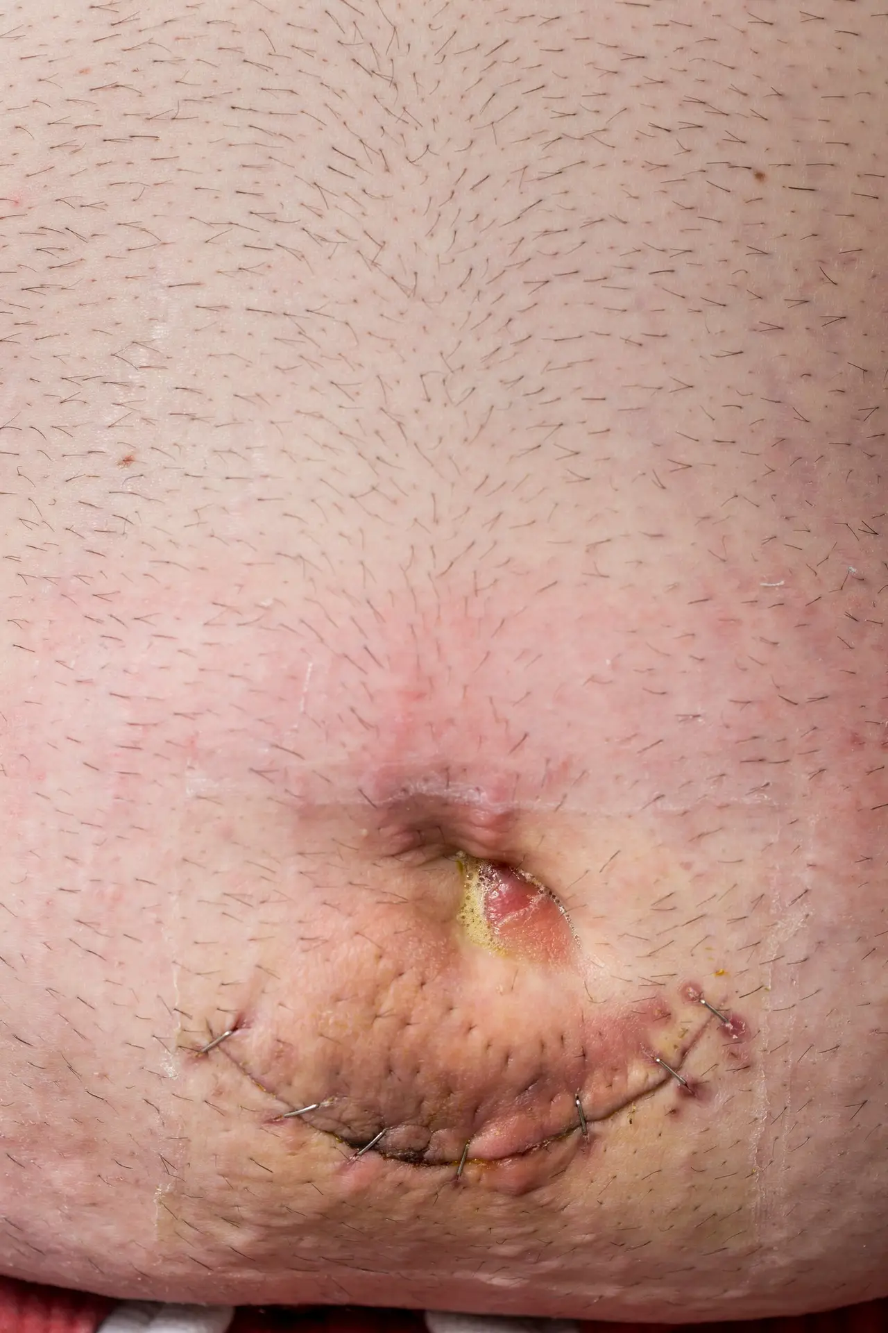 Umbilical hernia wound