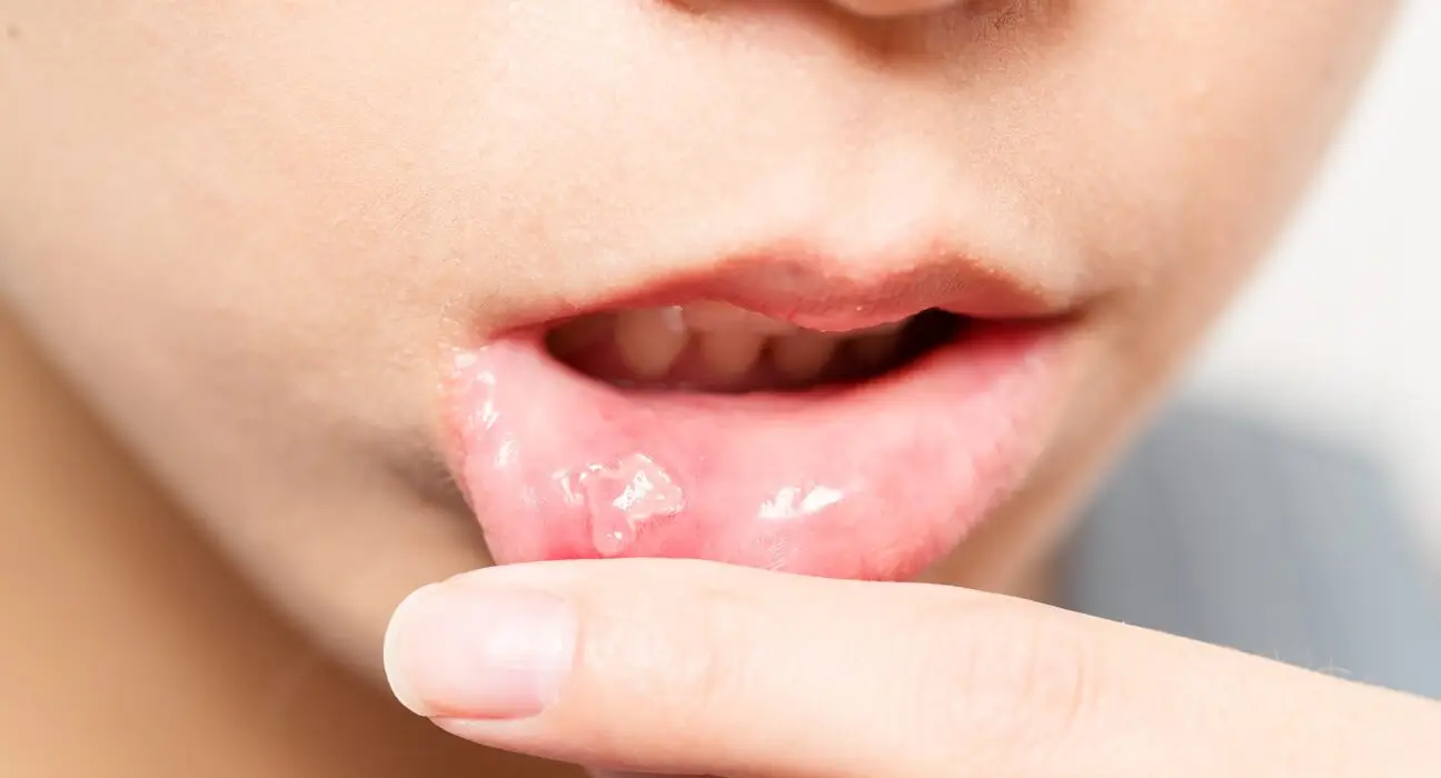 Woman suffer from mouth aphtha