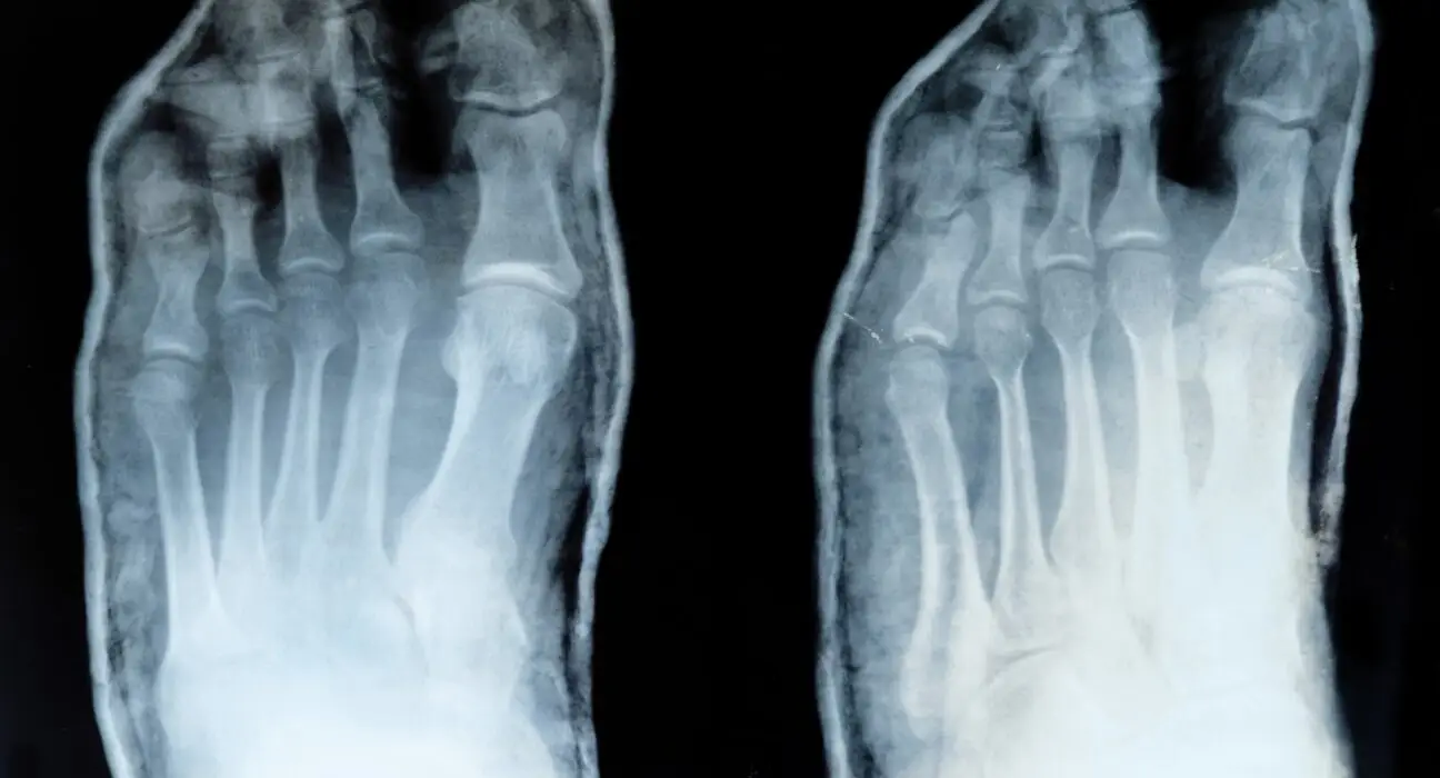 x-ray of toes, with displaced little finger