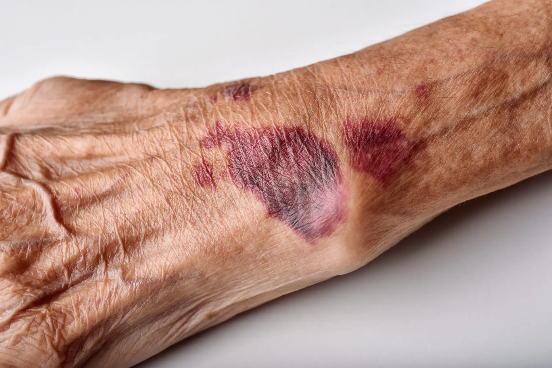 Bruise Wound On Senior People Wrist Arm Skin, Falls Injury Accident In Elderly Old Man.