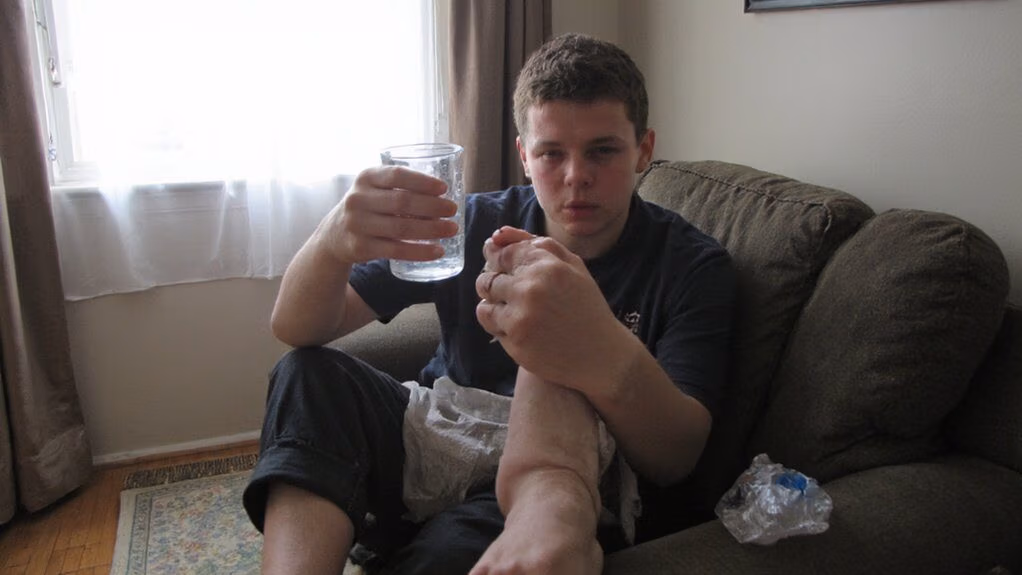 early dilutional hyponatremia symptoms