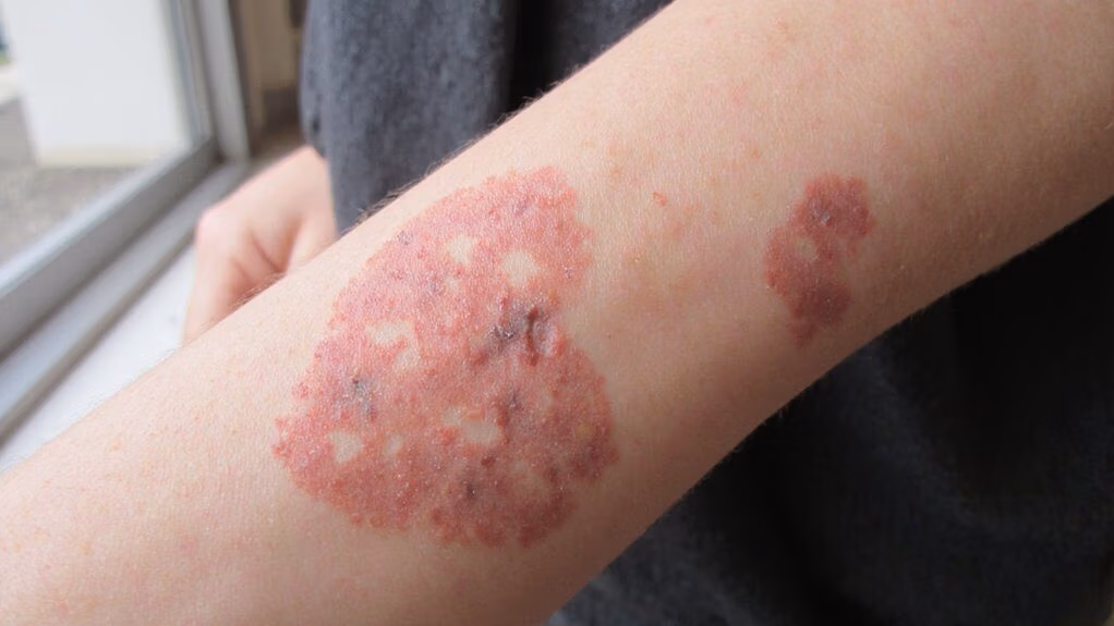 iga mediated dermatitis herpetiformis rash