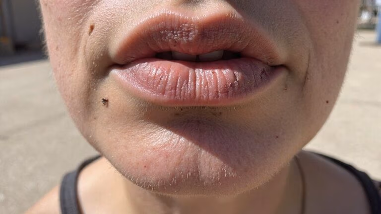 symptoms of severe dehydration