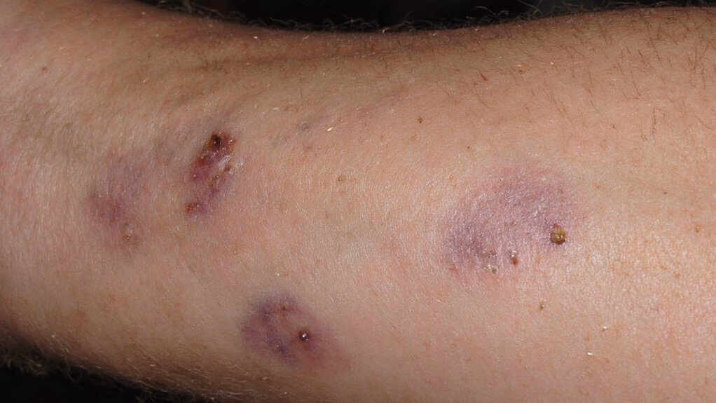 fragile capillaries easy bruising